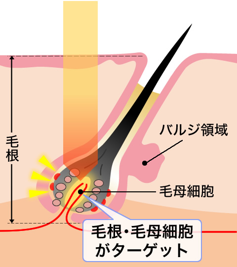 ヒゲ脱毛｜メンズ(男性)の医療脱毛・医療レーザー脱毛なら湘南美容クリニック【公式】｜美容整形・美容外科