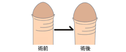 泌尿器科の医師が解説】亀頭を大きくする４つの方法を徹底検証