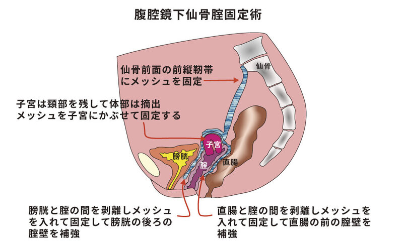 直腸瘤と排便障害～直腸瘤は便秘の原因？結果？～｜市民のみなさまへ｜日本大腸肛門病学会