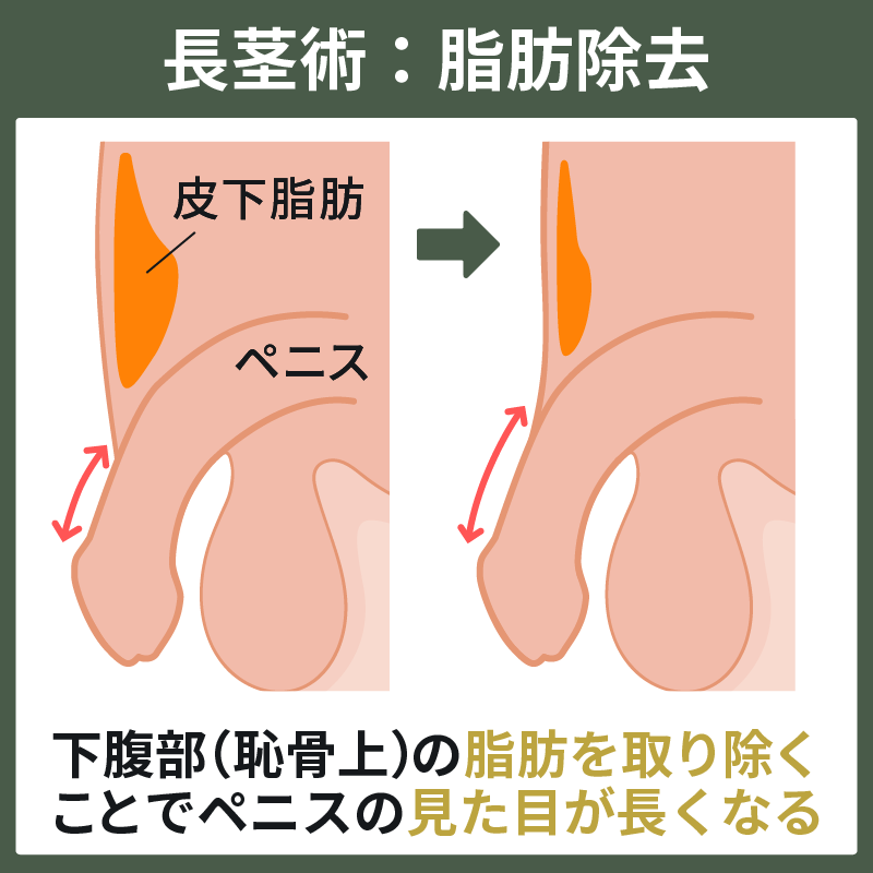 ペニスを大きくする方法 | 亀頭増大・長茎術・薬・サプリ・チントレなど