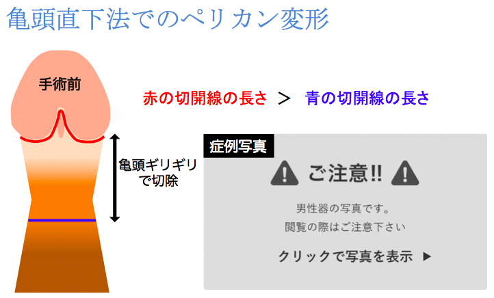 カントン包茎（嵌頓包茎）とは？手術と費用について｜MSクリニック