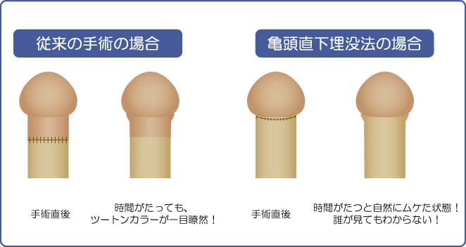 亀頭包皮炎は自然治癒する？|『治すための方法』と『病院に行くべきタイミング』を解説 | 泌尿器科｜GOETHE メンズクリニック東京駅