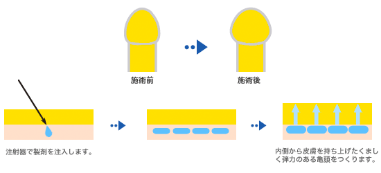 亀頭が痛い、敏感すぎるのは包茎が原因？包茎治療や自力での改善方法を紹介 | メンズライフクリニック【公式】