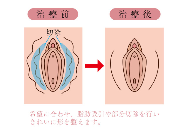 クリトリス包茎 ： 婦人科・女性器：美容外科 高須クリニック