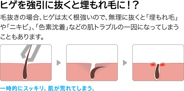 男の肌荒れ】髭を抜くと色素沈着が発生する？！黒ずみ・シミを治す方法と肌トラブルを引き起こさない処理法とは | まるわかりメンズ脱毛