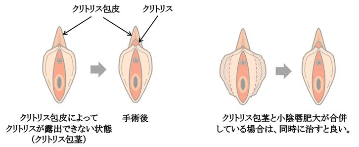 クリトリスの皮を剥くコツは？クリイキするための正しい剥き方をイラストでチェック