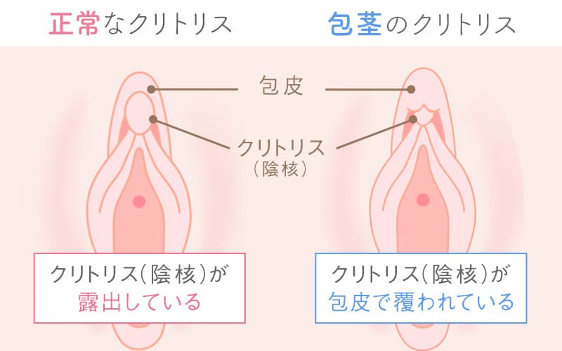 クリトリス包茎手術｜見た目・感度を改善！女性器整形「クリトリス包茎手術」の効果・経過・ダウンタイムとは｜美容整形・美容外科のTAクリニックグループ