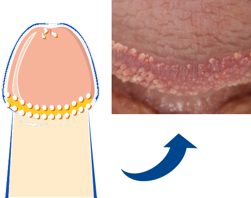 亀頭・陰茎のブツブツ除去｜MSクリニック