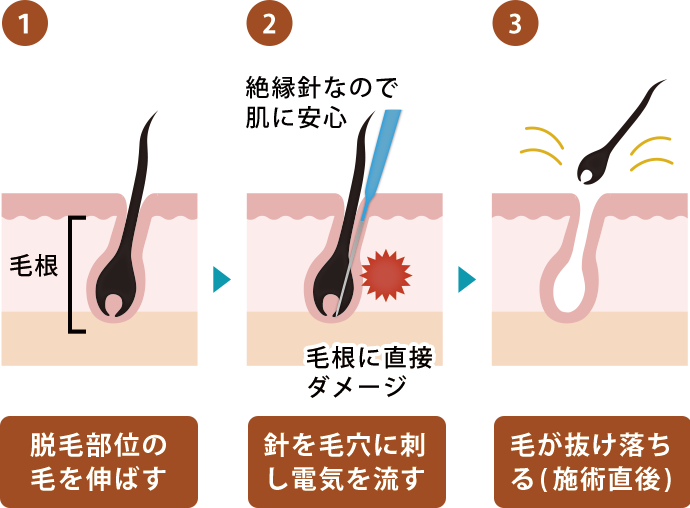 ヒゲの毛抜きは危険？デメリットとヒゲのおすすめ処理方法を解説 | レーザースキンクリニック