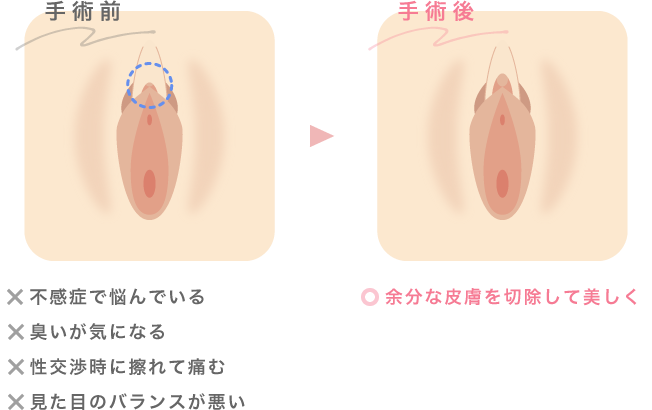 仮性包茎 | エーツークリニック