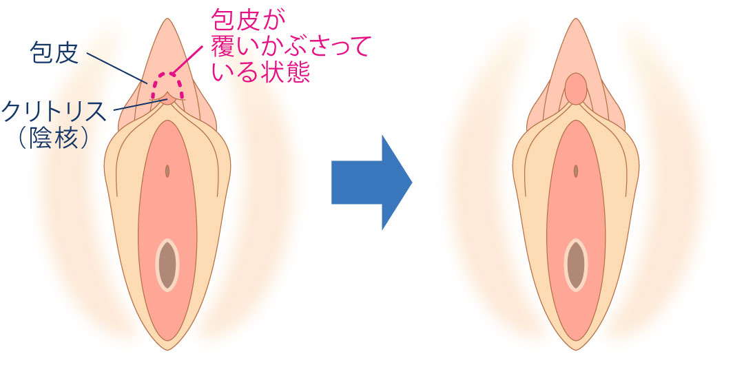 クリトリス（陰核）包茎手術 | 婦人科形成 |