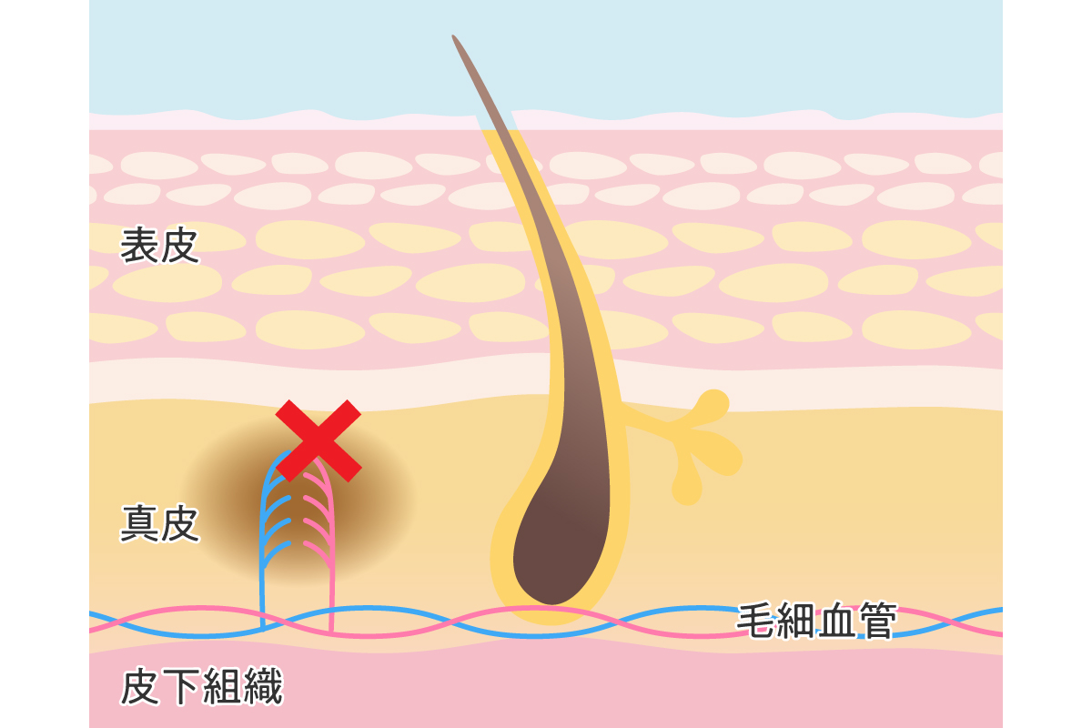 緊急】キスマークの消し方・隠し方をご紹介！それでも指摘された時の言い訳は？