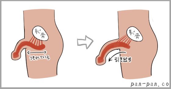 亀頭増大術・陰茎増大術 | エーツークリニック