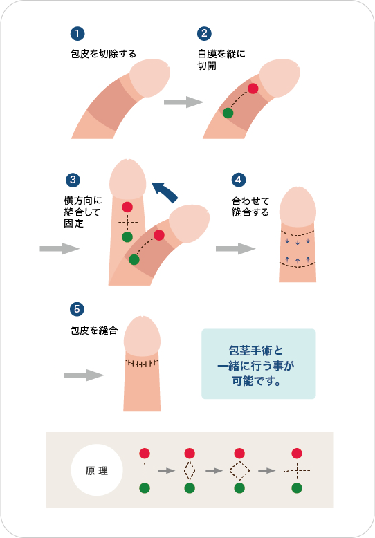 ペニスの曲がり】上反りちんこでの激痛と改善法を解説【アナル挿入の向きと角度】 - エロいアナル大好き！アダルトアブノーマルな出会い