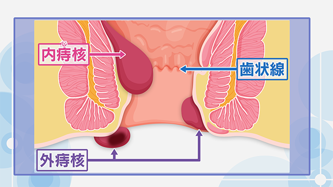 ボラギノールM軟膏｜ボラギノール公式ブランドサイト