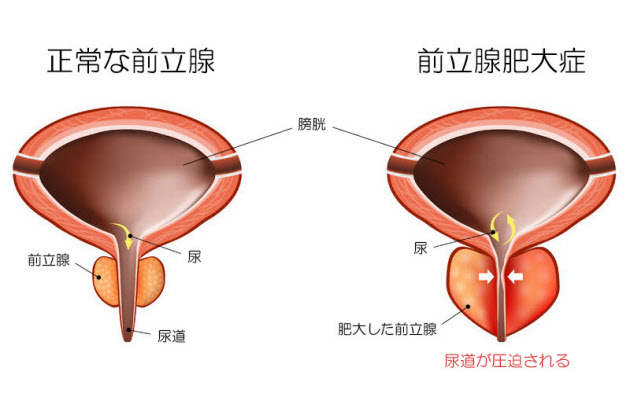 前立腺がん｜診療内容｜泌尿器科｜独立行政法人国立病院機構 京都医療センター