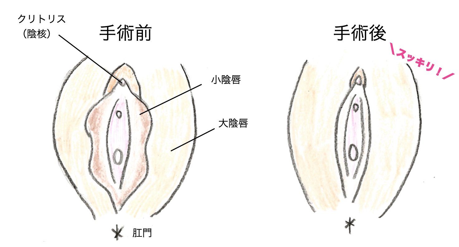 クリトリスの皮が剥けて…」婦人科の相談。もくようさん（32歳/女性）の投稿。【CARADA 健康相談】  医師や専門家に相談できるQ&Aサイト。30万件以上のお悩みに回答