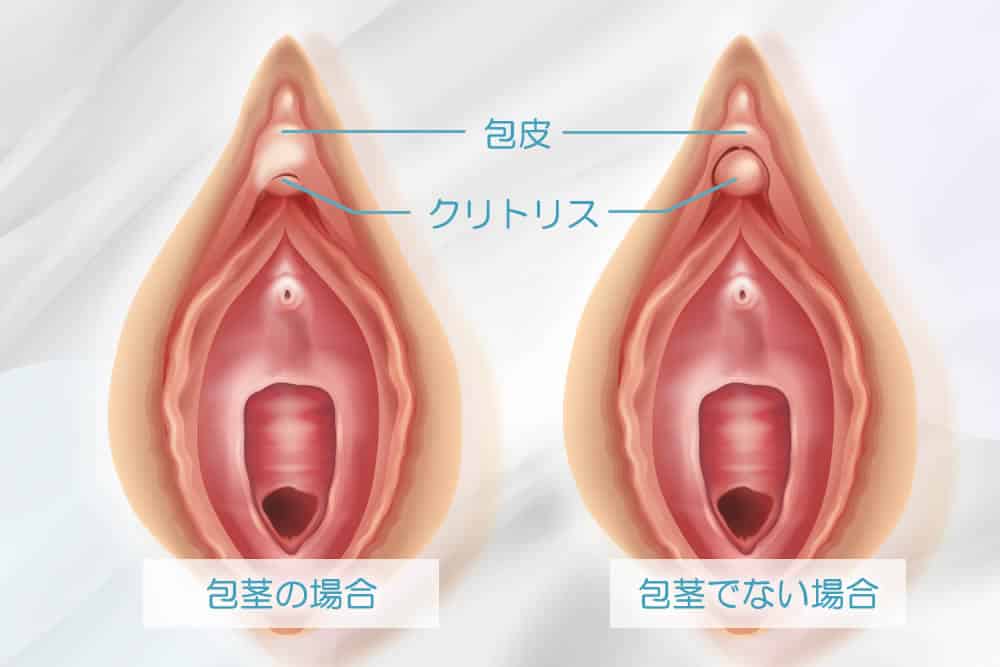 クリトリス(陰核)包茎｜美容外科・美容整形なら宮崎・大分・東京の経験豊富なコムロクリニック