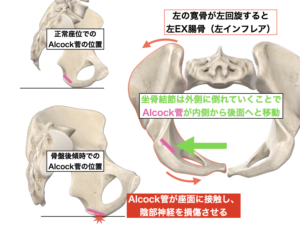 骨盤臓器脱サポーター メディカル・テイキン 通販 -