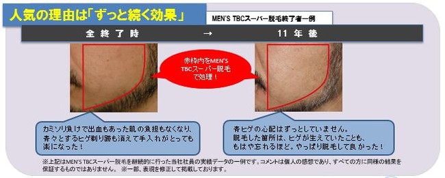 体験談】メンズTBCのヒゲ脱毛は痛い？3社の痛みと効果を比較！ | ヒゲ脱毛ガイド