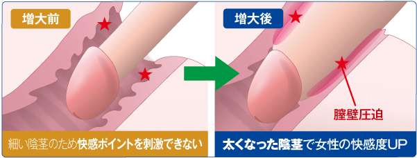 亀頭下直線切開包茎手術（クランプ法） ： 男性器（包茎、長茎など）：美容外科 高須クリニック