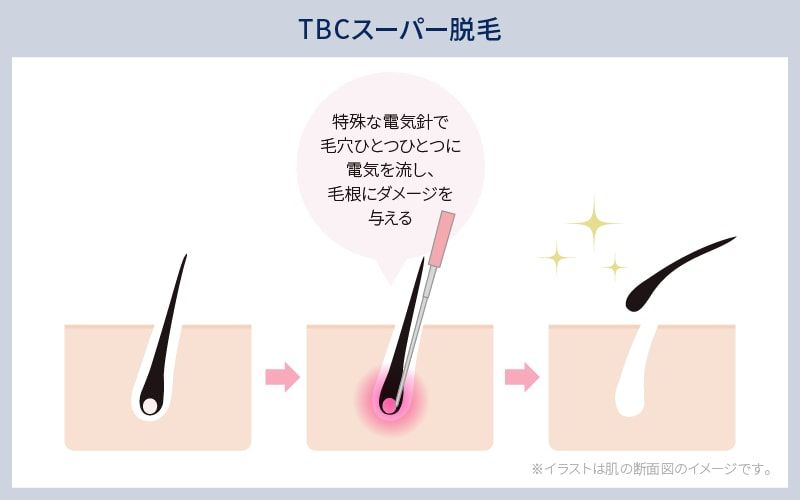 メンズTBCの脱毛料金、予約方法、効果、口コミを紹介｜ヒゲ脱毛はいくらかかる？ | エピステ