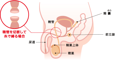 避妊手術 | 避妊のススメ