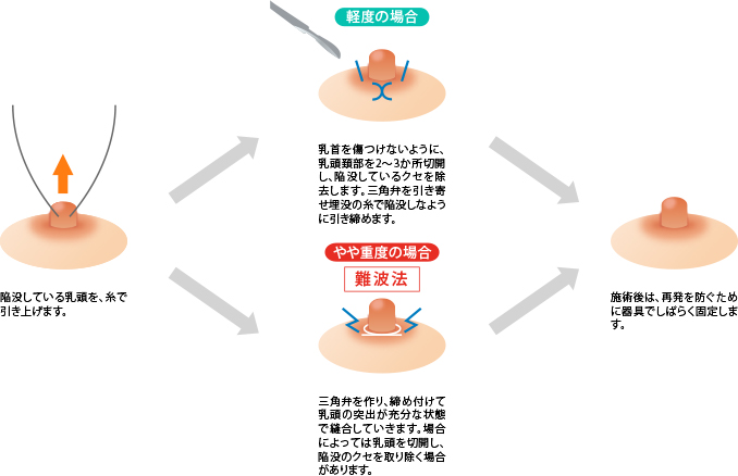 乳首が立つ。大きな乳首に悩んでいる。それ、女性化乳房かもしれません