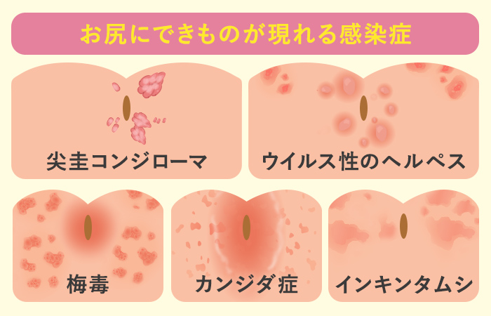 お尻のできもの(ぶつぶつ)はニキビ？原因と対処法|天神マイケアクリニック