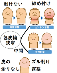 包茎手術で後悔しない人気クリニックと知っておきたい失敗例・デメリット