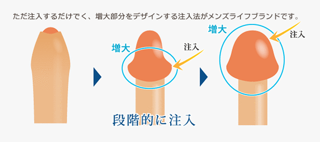 カリ高ペニスになる方法は？カリ高の基準や亀頭を大きくするメリットも解説！ | Men's Chinchi