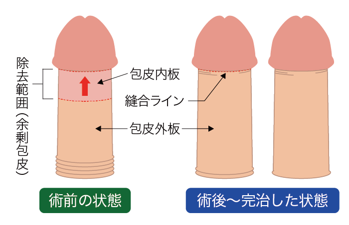 仮性包茎 補助テープ 『MUKETE ムケテ』＆ フェロモン