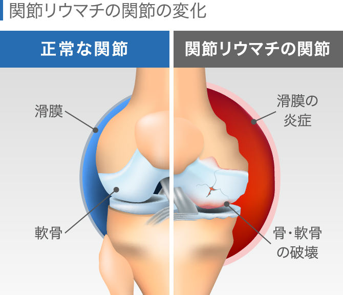 膝に違和感がある時考えられる病気・ストレッチ方法｜クリニークハル大阪梅田