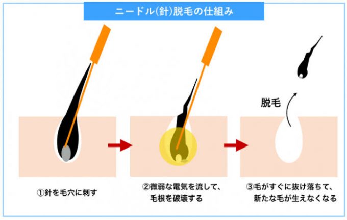 硬毛化とは？見分け方から考えられる原因と対策と治療法