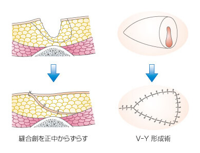 おしりのただれ・かゆみにおすすめの市販薬10選【薬剤師が厳選】 – EPARKくすりの窓口コラム｜ヘルスケア情報