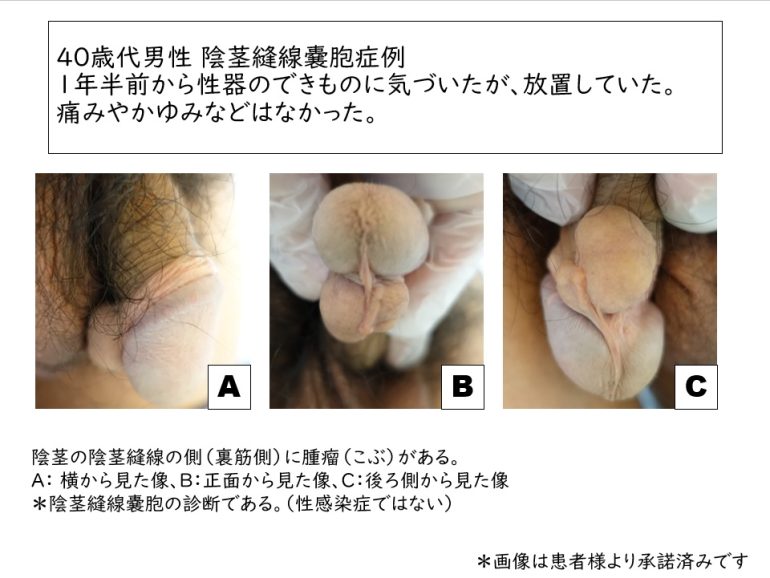 男性器に曲がりや痛み～中高年に多いペロニー病（東邦大学医療センター大森病院泌尿器科 三井要造講師）～｜医療ニュース  トピックス｜時事メディカル｜時事通信の医療ニュースサイト