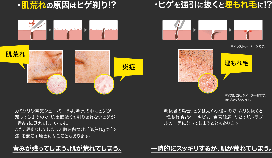 髭脱毛で肌荒れ・ニキビになったら？失敗例と副作用を防ぐための方法 | MOTEO