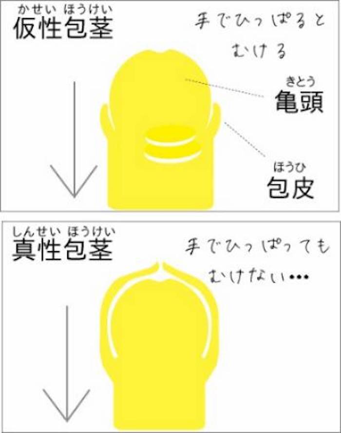 包茎｜神戸市東灘区 摂津本山｜いしむら腎泌尿器科クリニック