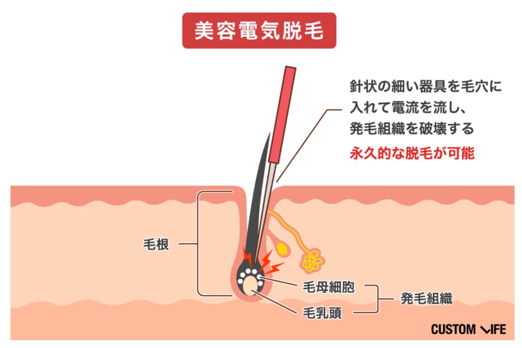 満足度９８.８%「TBCスーパー脱毛」はここまでスゴかった！３２年間 １度も剃る抜くしていないワキ公開！両ワキ体験キャンペーン実施中！ 