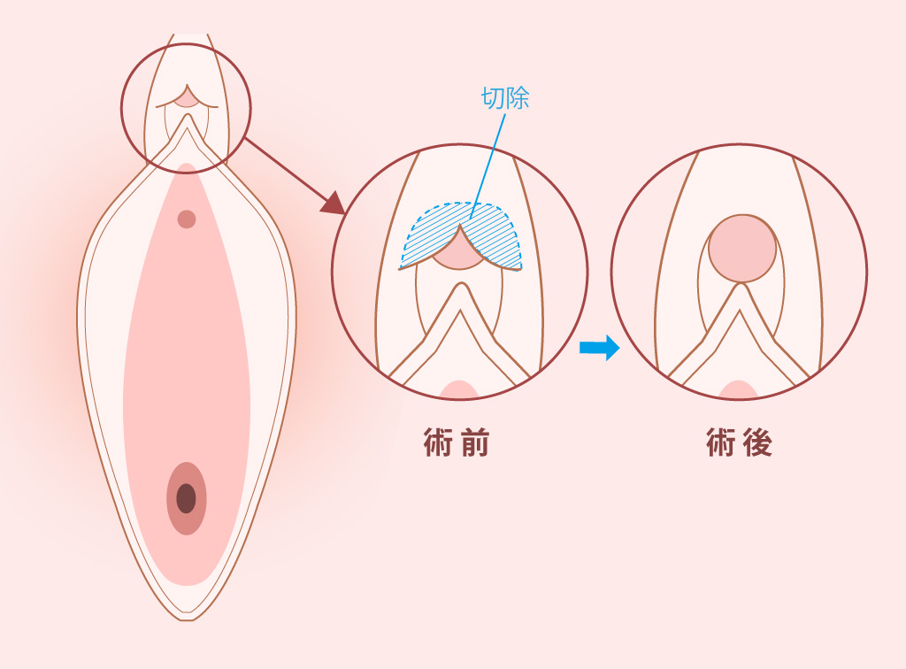 陰核(クリトリス)包茎手術｜うめきた美容クリニック【公式】｜大阪・梅田の美容外科・美容皮膚科