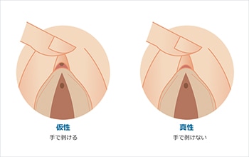 クリトリス(陰核)包茎｜美容外科・美容整形なら宮崎・大分・東京の経験豊富なコムロクリニック