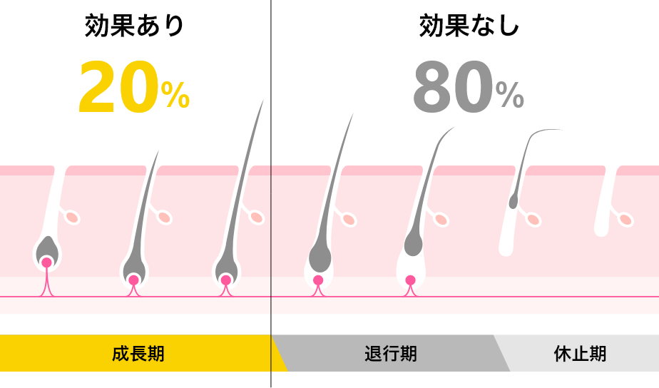 ヒゲ脱毛後は濃くなる？どろぼうひげになる理由や対処法も解説 | エミナルクリニックメンズ(メンズエミナル)