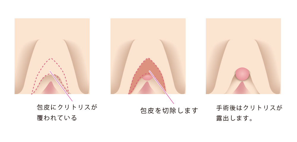 クリトリス包茎と陰核の機能について - 美容外科｜船橋中央クリニック&青山セレスクリニック