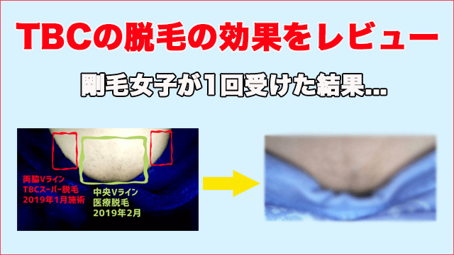 TBC脱毛の口コミ評判はぶっちゃげどう？人気のTBCスーパー脱毛の効果＆痛みを体験レポート - CUSTOMLIFE(カスタムライフ)