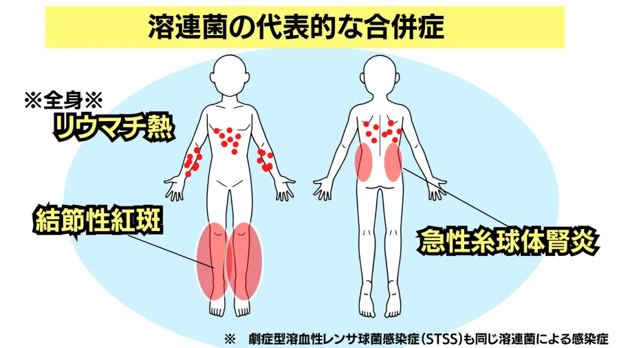 急性扁桃炎・咽頭炎 の症状・治療｜たぶち耳鼻咽喉科｜寝屋川市・門真市・四條畷市の気道食道科