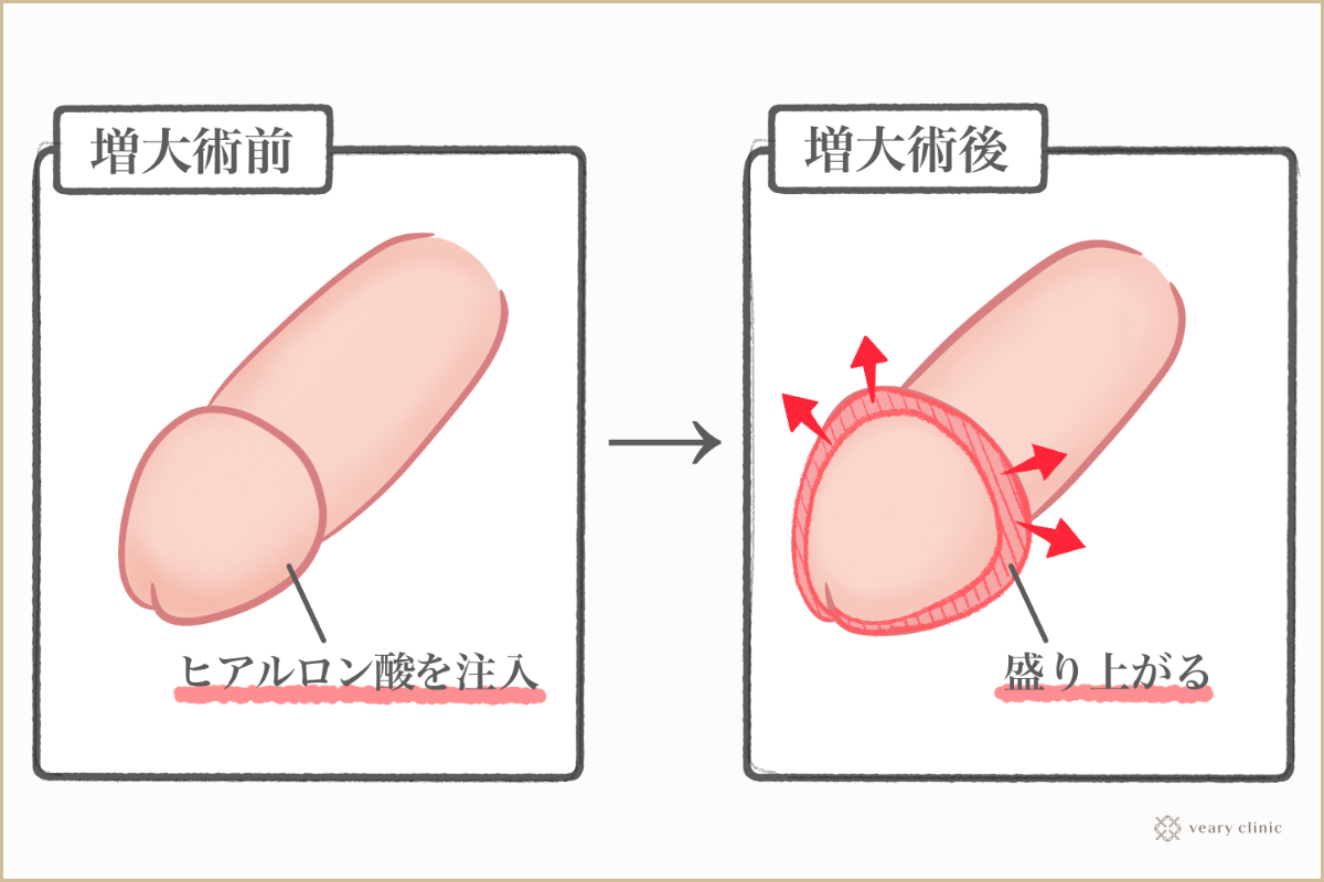 泌尿器科専門医が警告】亀頭増大に潜む『壊死』のリスク・注入成分一覧付