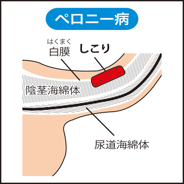 勃起の角度は何度が平均？低い原因や上向きにする方法を解説 |【公式】ユナイテッドクリニック