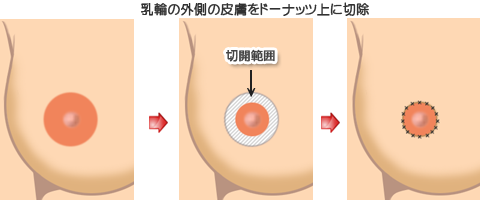 乳輪縮小】他院修正 40代女性【症例No.29Y012140】 | 樹のひかり形成外科・皮ふ科【奈良】｜美容整形・美容皮膚科クリニック