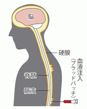 硬膜外麻酔（エピ）の穿刺部位と手順【マンガでわかる看護技術】 | ナース専科