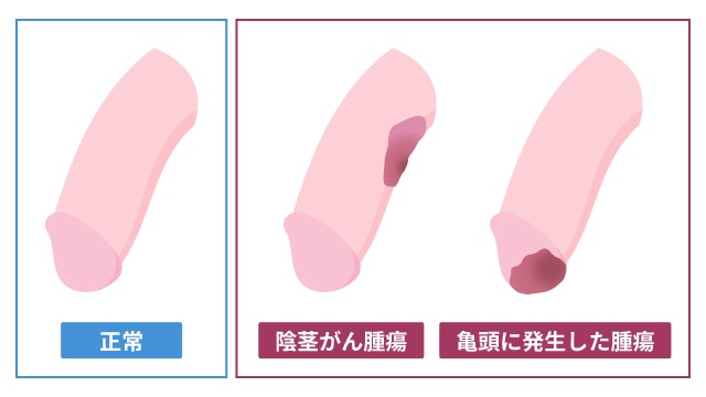 血精液症の解説 症状や原因・治療について│STD研究所